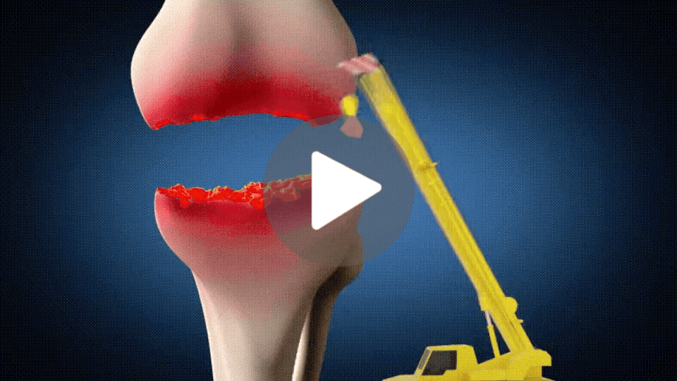 Natural Joint Support Method